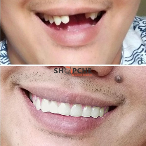 Комплект от горна и долна иновативни протези Snap on smile